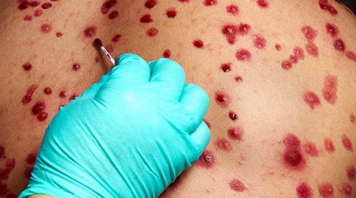 viruela-del-mono-1-800x445-1-696x387